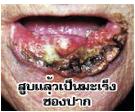 Thailand 2006 Health Effects mouth - diseased organ, oral cancer, gross